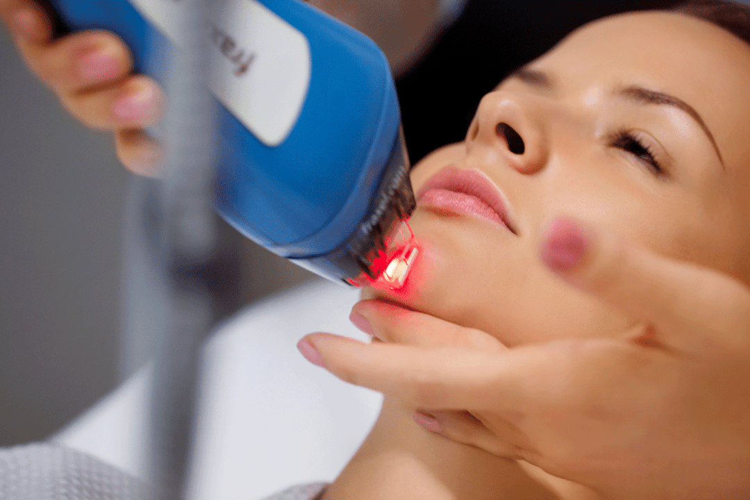 resurfaçage laser de la peau du visage
