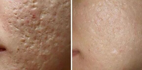 Cicatrices laser