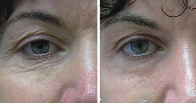 Laser en cuir autour des yeux